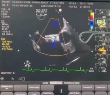 FOP procedure with CeraFlex™️