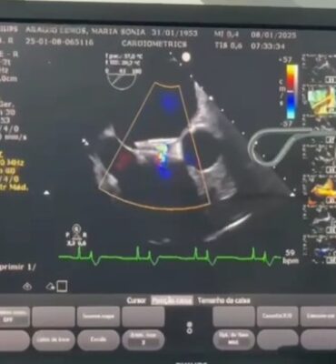 Procedimento FOP com CeraFlex™️